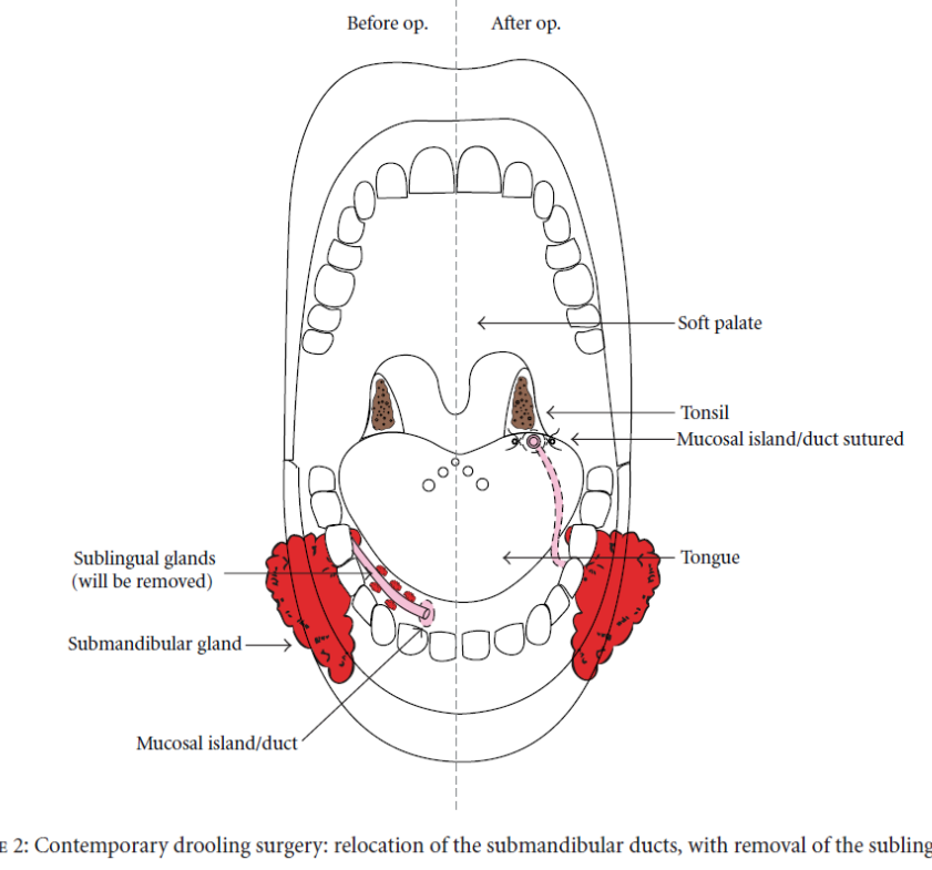 <p>Gecombineerd met excisie sublinguale speekselklieren </p><p>Enkel indien geen aspiratierisico </p><p>Effectief op lange termijn</p>