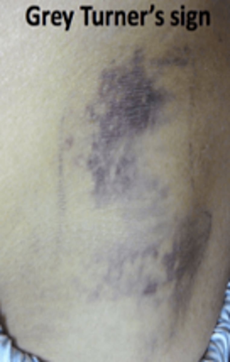 <p>Bluish discoloration of the flanks from retroperitoneal hemorrhage</p><p>PANCREATITIS SIGN</p>