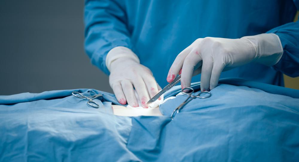 <p>ectomy (suffix)</p>