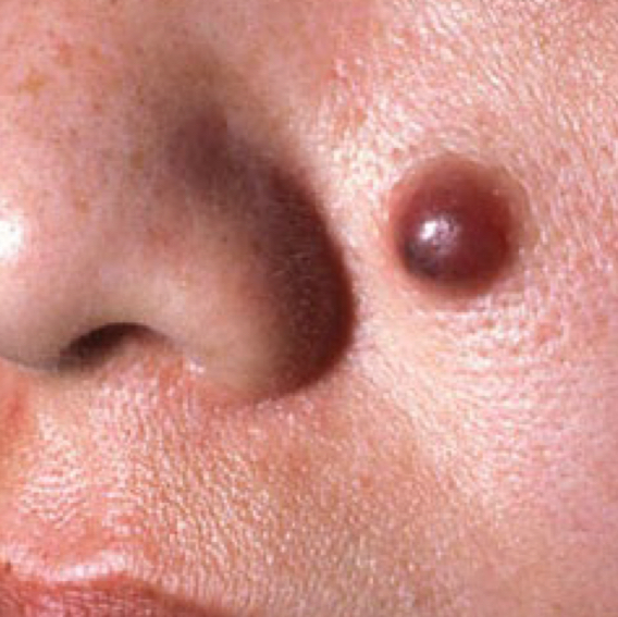 <p>what type of lesion and condition is depicted</p>