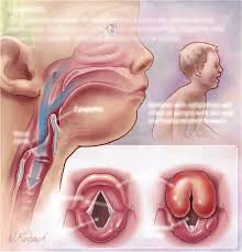 <p>epiglotitis</p>