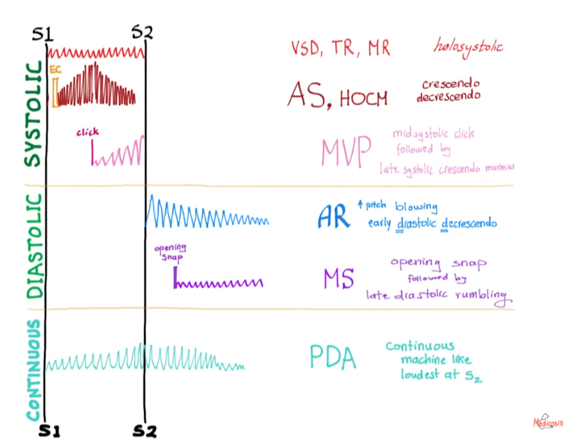 <p>Early diastolic, decrescendo hight-pitched blowing murmur, best heard along the lower left sternal body 2 intercostal space.</p><p></p><div data-youtube-video=""><iframe width="640" height="480" allowfullscreen="true" autoplay="false" disablekbcontrols="false" enableiframeapi="false" endtime="0" ivloadpolicy="0" loop="false" modestbranding="false" origin="" playlist="" src="https://www.youtube.com/embed/uZysrKXHJMM" start="0"></iframe></div><p></p>