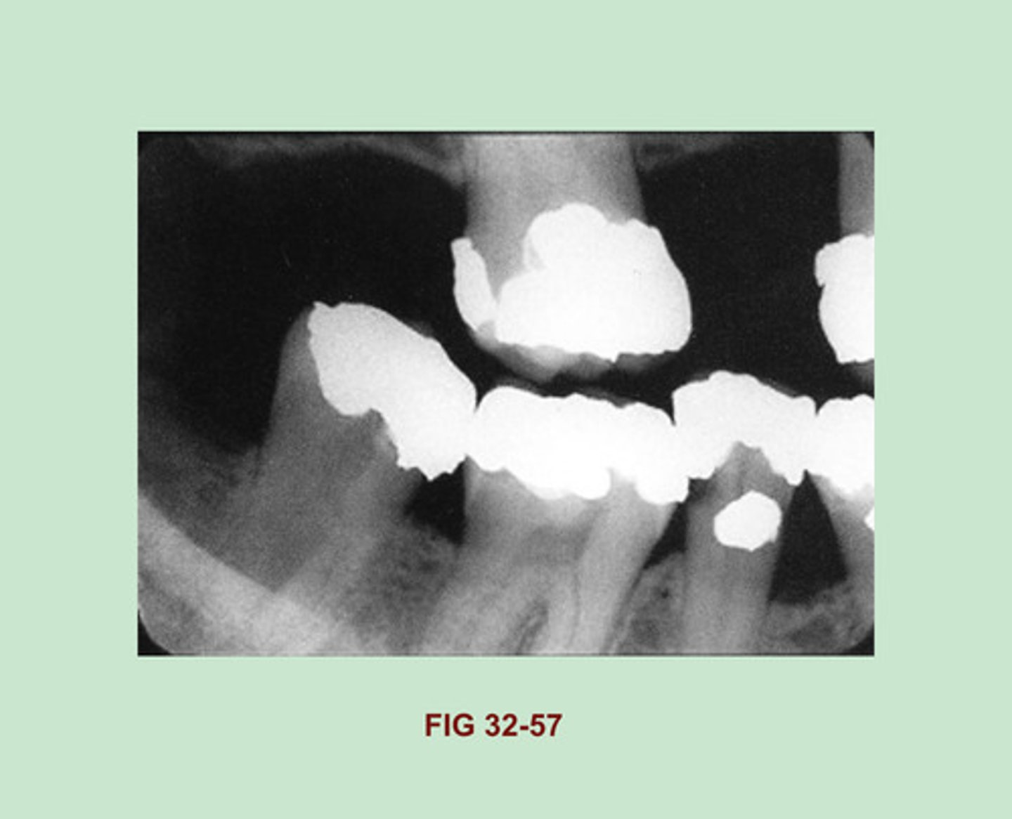 <p>Gold Foil Restorations</p><p>Side Note: One-surface gold foil restorations appear as small round radiopacities on a dental image and are indistinguishable from one-surface amalgam restorations. A two-surface gold foil restoration may appear similar to a gold inlay, with smooth, regular marginal outlines, or may exhibit slightly irregular margins & resemble a two-surface amalgam.</p>