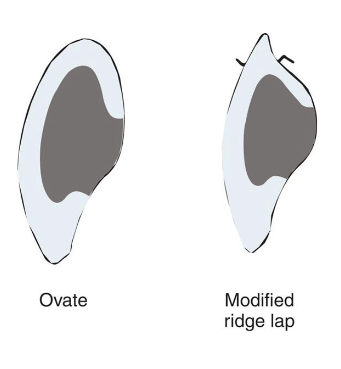 <p>the broad convex geometry makes it stronger because the porcelain at the gingivofacial extent of a pontic is supported </p>