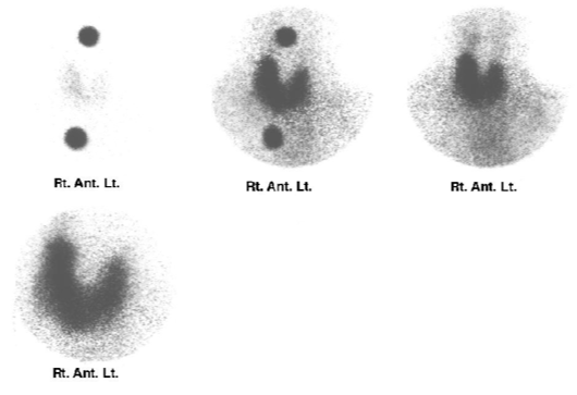 <p>Uptake was 10.15%. Is this scan normal or abnormal</p>