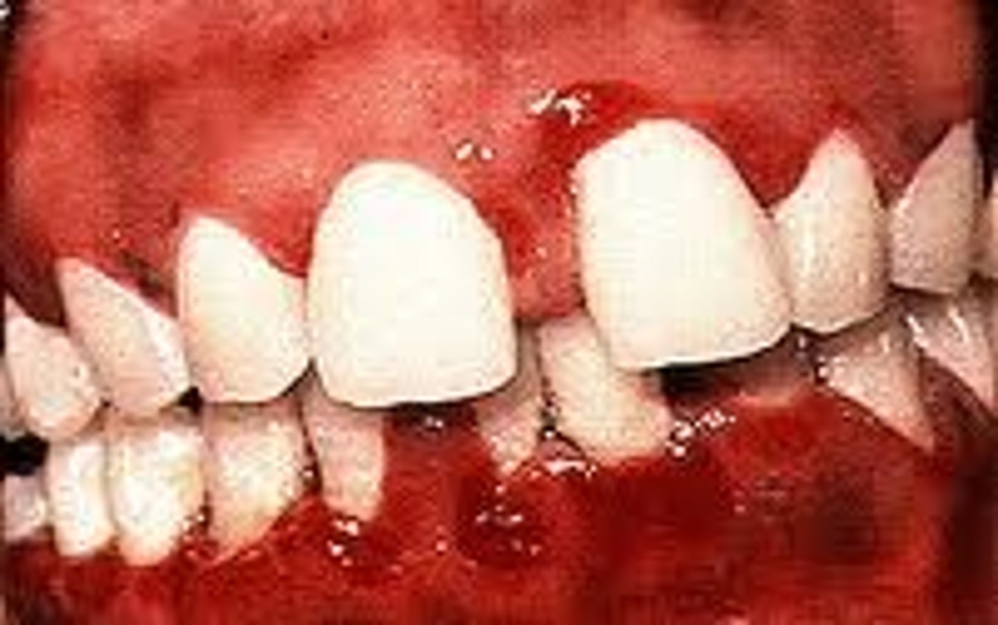 <p>Oral Pain, Halitosis, Ulceration</p><p>metallic taste, tooth mobility, lymphadenopathy</p>
