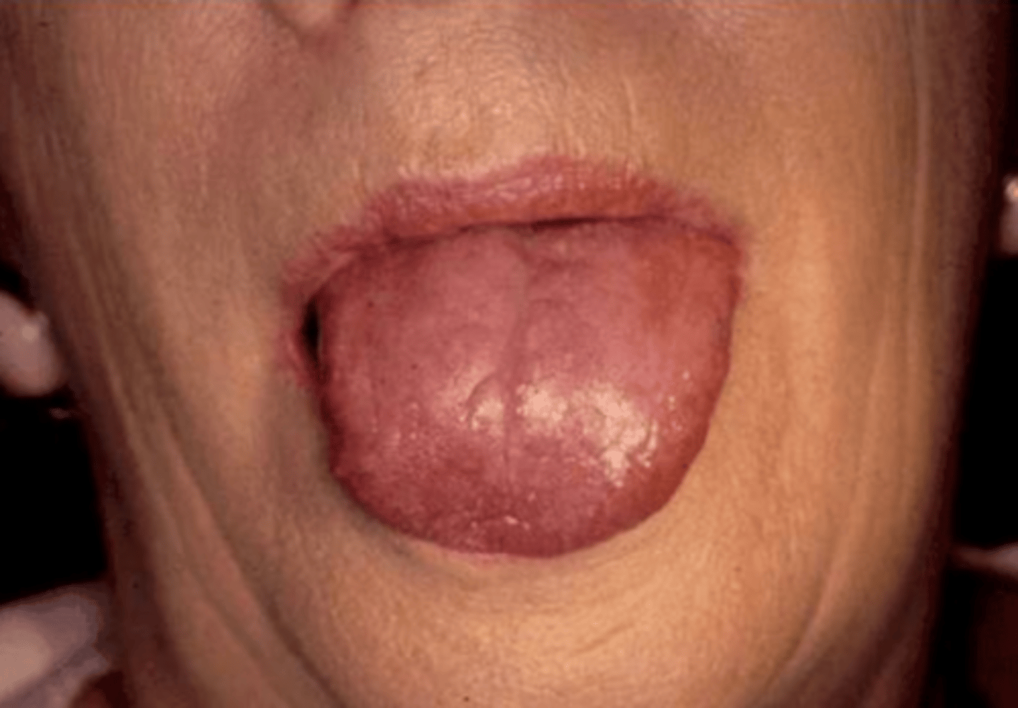 <p>Sjogren syndrome</p>