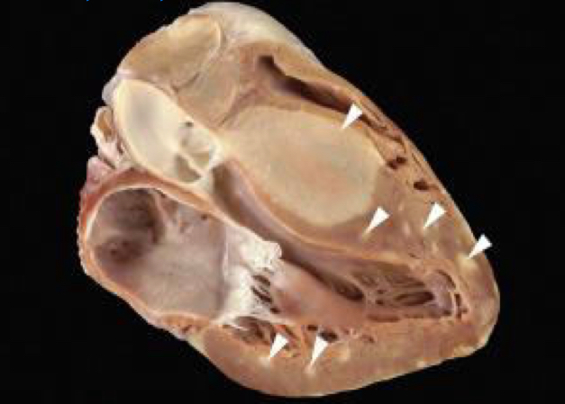 <p>Traits of rhabdomyomas</p>