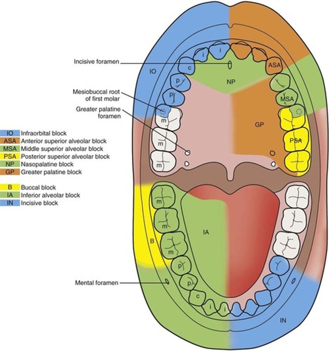<p>used to anesthetize almost all of the tissue and teeth on one side of the mandible. Except for the buccal mucosa of the mandibular molars</p>