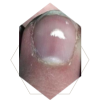 <p>What’s this called &amp; what’s it a sign of </p>