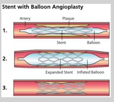 <ul><li><p>PCI—&gt; <strong>procedure to open blocked or narrowed coronary arteries</strong></p><ul><li><p>balloon angioplasty ± stent placement</p></li></ul></li></ul><p></p>