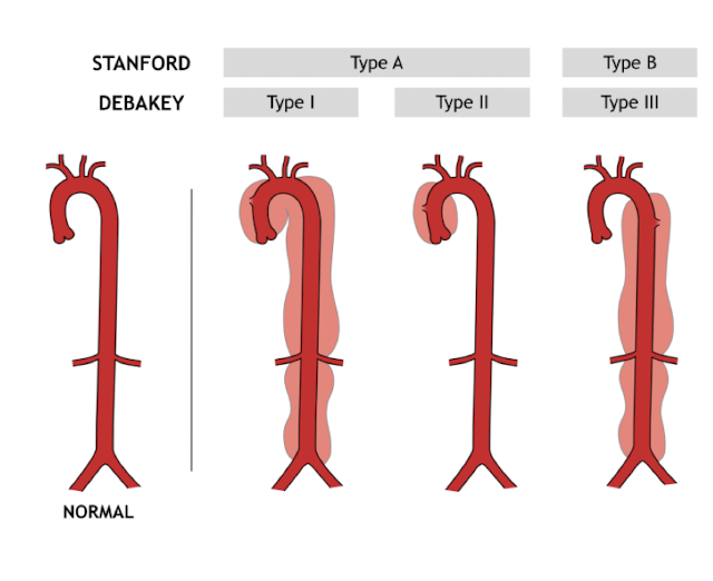 <p><strong>Failure of the aortic intima (90%)</strong></p><p><em>risk factors:</em> Coarctation<strong> </strong>of<strong> </strong>aorta, Cocaine, Connective tissue disease, Bicuspid aortic valve, Thoracic trauma, Recent instrumentation (cardiac cath, aortic valve replacement), Uncontrolled hypertension</p><p>S/S: <span style="color: red"><strong>sudden, severe, maximal intensity pain at onset of chest or midline abdominal pain</strong></span></p><p><span style="color: blue">CXR: <strong>widening of mediastinum</strong></span><strong>, </strong>Tropinin, D-Dimer, CT</p><p><strong>Tx: </strong>IV and NPO, Analgesia, <span style="color: green"><strong>Heart rate and blood pressure control </strong>(IV beta blockers or calcium channel blocker)</span><br><span style="color: red"><strong><em>Type A (ascending aorta) requires emergent repair</em></strong></span></p>