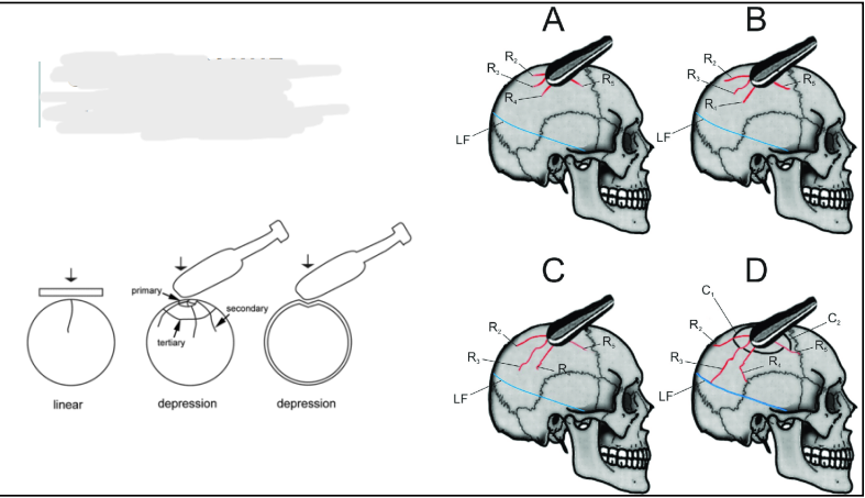 <p>Fractures follow paths of least resistance, avoiding strong buttresses like the frontal midline, petrous temporal, and mastoid. Instead, they often travel through thinner bone areas, adjacent orbits, or along sutures—natural weak points in the skull</p>