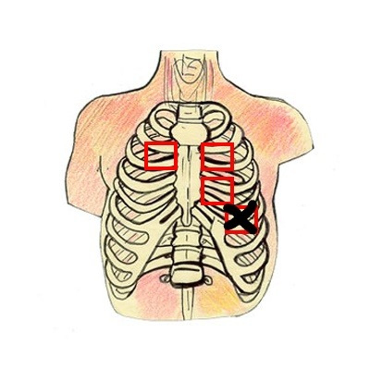 <p>The nurse should auscultate the apical pulse in the 5th intercostal space, on the left side of the chest, over the apex of the heart</p>