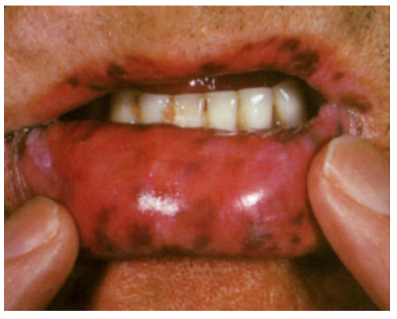 <p>An autosomal dominant disorder of the serine threanonine kinase 11 gene that is characterized by polyps throughout the intestines (usually small), pigmented macules on lips, GI cancers (60% of patients), breast cancer (50% of patients)</p>