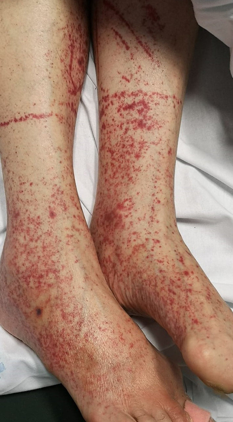 <p>petechiae</p>