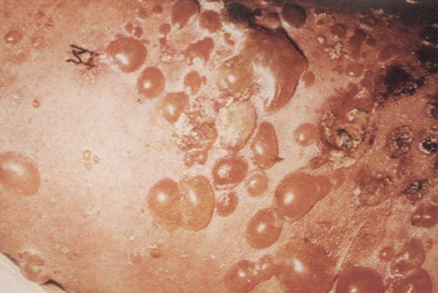 <p>diagnose this:</p><p>prodrome of pruritic and urticarial papules -> progresses to large tense bullae--> Bullae are tense, hard to rupture (- Nikolsky sign)</p>