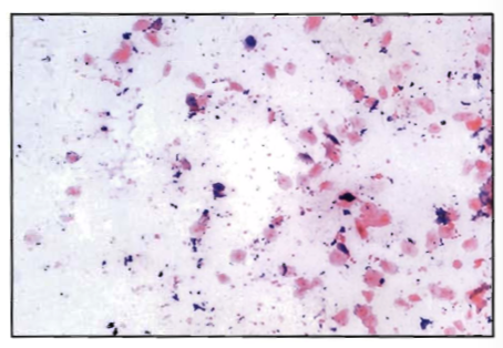 <p>A sputum specimen is recieved for culture and Gram stain. The Gram stained smear from this specimen is seen in the image (total magnification 100X):</p><p>See BOC pg 288</p><p>The technologist's best course of action would be to:</p><p>A. inoculate appropriate media and incubate anaerobically</p><p>B. inoculate appropriate media and incubate aerobically</p><p>C. call the physician and notify him of this "life-threatening" situation</p><p>D. call the patient care area and request a new specimen</p>