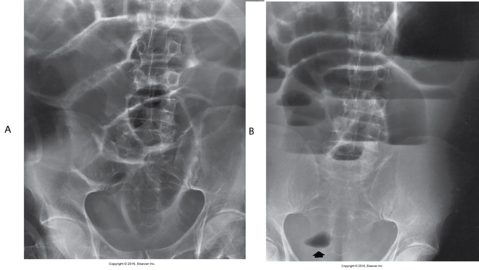 Supine (A) and upright (B) projections demonstrate large amounts of gas in dilated loops of small bowel. (B) Image taken with the patient in the upright position and using a horizontal beam demonstrates multiple prominent air-fluid levels.
