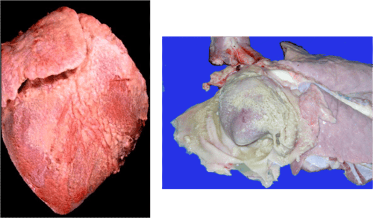 <p>Pericardial sac contains effusion rich in fibrin that clots soon after exposure to air</p>