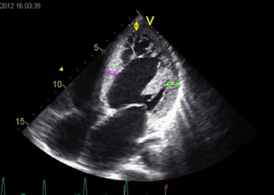 <p>1. What view is this?</p><p>2. What is wrong with this image? (Do not worry about pathology)</p><p>3. What would we do to correct this image? Be specific, how would we manipulate the transducer?</p>
