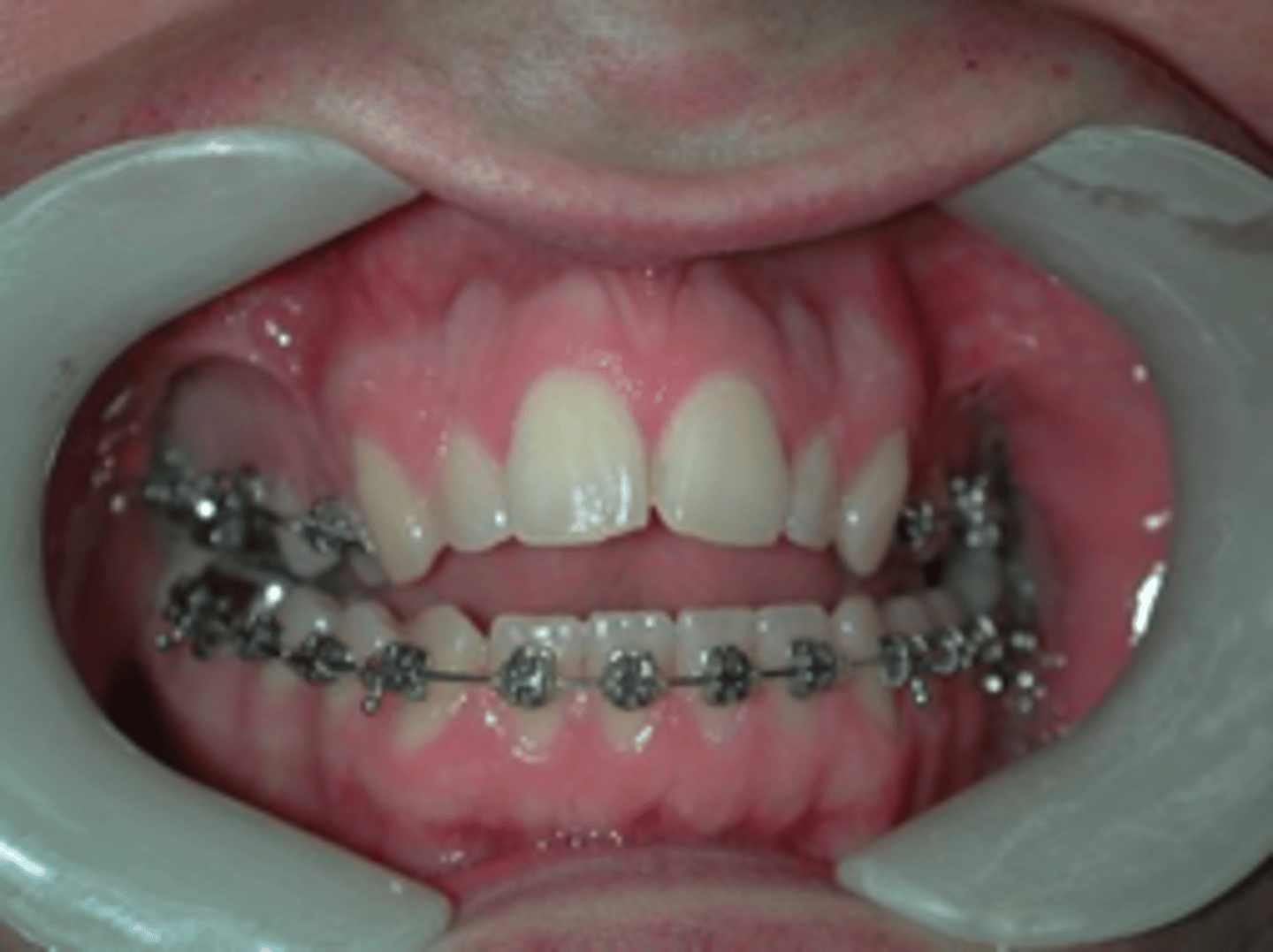 <p>What surgery is indicated for a patient with a maxillary transverse discrepancy:</p>