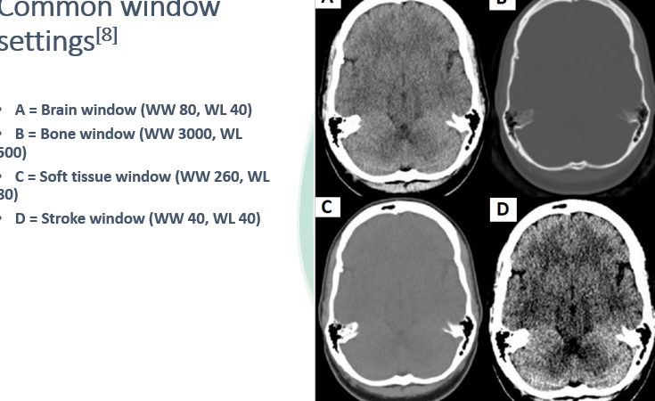 <p><span>•Window settings are used to <strong>aid detection of pathologies </strong>involving the brain substance (e.g. infarcts), the skull vault (e.g. fractures) or soft tissues (e.g. haematomas).</span></p><p><span>•Window settings are <strong>described in terms of window width (WW) and window level (WL)</strong> – these values are typically displayed on the computer screen.</span></p><p><span>•WW = the range of grey-scales displayed</span></p><p><span>•WL = the centre of the WW</span></p><p><span>•Altering the window settings helps reduce the range of HU displayed, which in turn helps to maximise the pickup rate of different pathologies.</span></p><p></p>