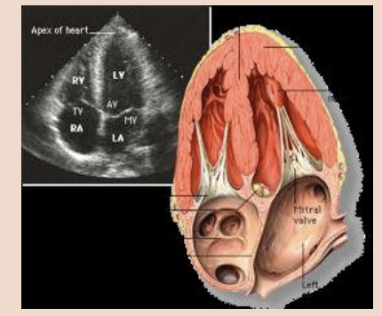 <p><span style="color: #000000">In this view, the transducer is placed at the point of maximum impulse if the patient has a palpable apical beat. Otherwise, it is placed in the fifth intercostal space near the anterior axillary line.</span><span style="color: #000000"><br></span><span style="color: #000000">• The beam is directed up towards the patient’s head, and the transducer is rotated so the marker is at around 3 o’clock.</span><span style="color: #000000"><br></span><span style="color: #000000">• This view is helpful for the identification of pericardial effusion (fluid between the heart and</span><span style="color: #000000"><br></span><span style="color: #000000">pericardium) which indicates cardiac tamponade, as well as RV dilation in pulmonary embolism.</span></p>