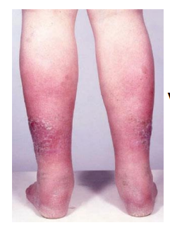 <p>what type of eczema is this?</p>