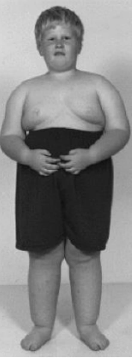 <p>Hypotonia, hypogonadism, hyperphagia, skin picking, agression.</p>