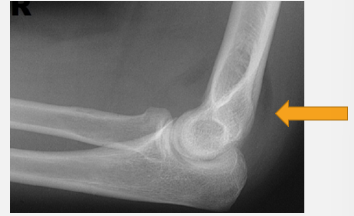 <p>an elbow fracture results in a</p>