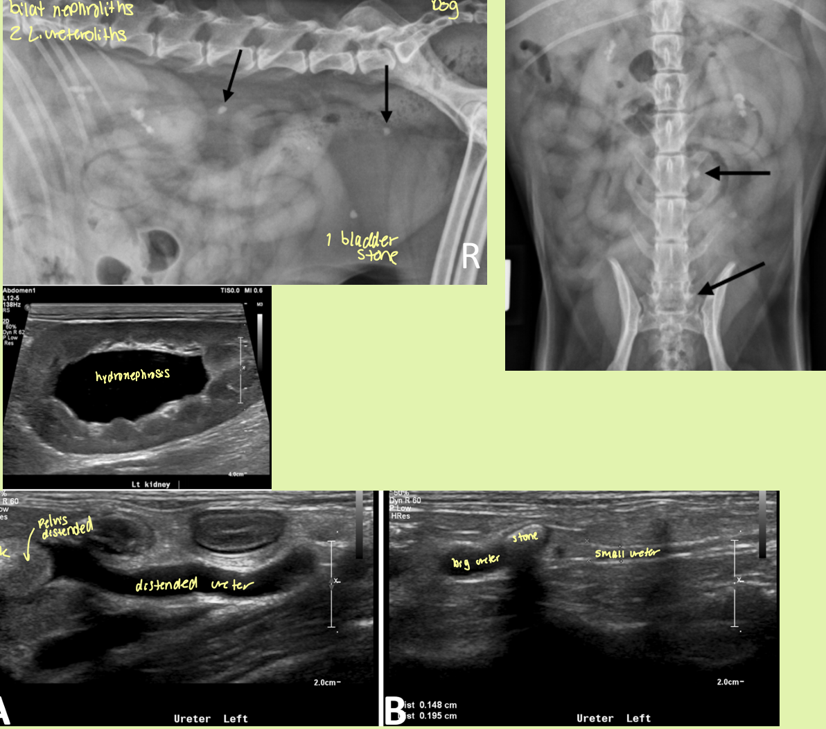 <p><span><strong><span>Rad findings - </span></strong><span>Can be seen</span></span></p><p style="text-align: left;"><span><strong><span>Ultrasound findings</span></strong></span></p><ul><li><p><span><span>hyperechoic structures with distal acoustic shadowing</span></span></p></li><li><p><span><span>Variable size</span></span></p></li><li><p><span><span>If obstruction—> hydronephrosis and hydroureter prox. and a normal ureter distally</span></span></p></li></ul><p></p>