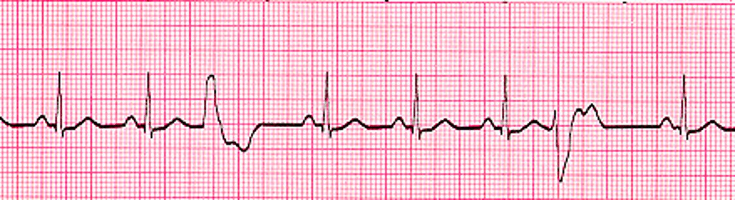 <p>rate: depends on underlying rhythm</p><p>rhythm: regular</p><p>P waves: may be absent</p><p>PR interval: &lt;0.12 seconds</p><p>QRS duration: &gt;0.12 seconds, wide, bizzare, abnormal</p>
