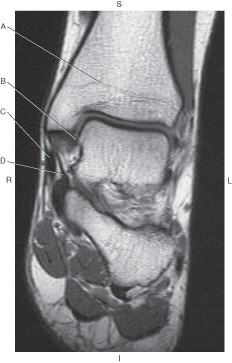 <p>In the figure below of a coronal, T1-weighted MRI of the ankle, which line points to the tibiotalar ligament?</p>