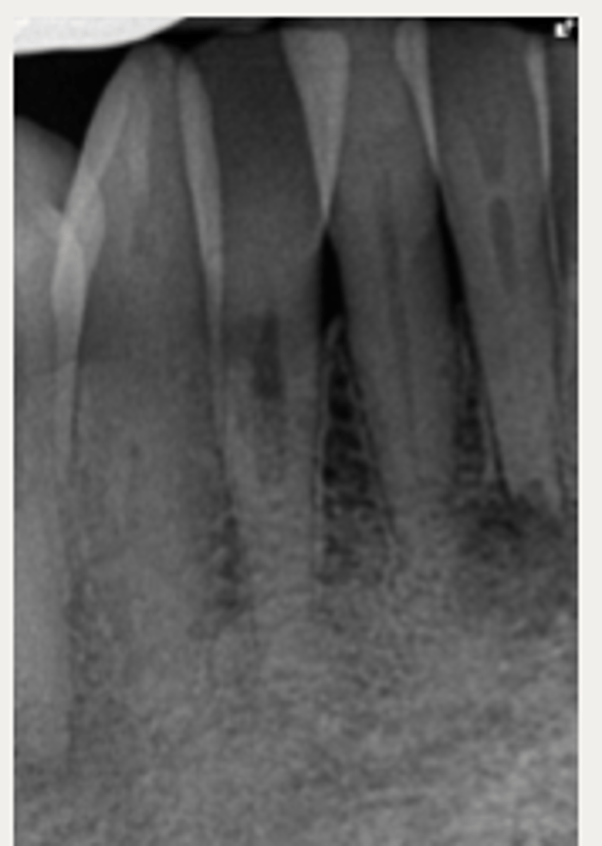 <p>These are a part of which treatment for External Cervical Resorption (ECR)? </p><p>- For lesions that are asymptomatic, but have progressed too far to treat without irreparable damage to tooth, or where the resorptive lesion is inaccessible to treatment</p>