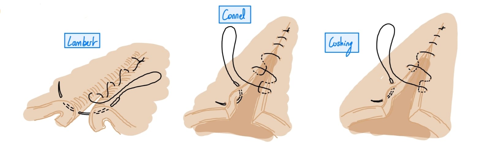 <p>With 2-0 to 3-0 absorbable sutures in two layers using a sero-muscular pattern </p><p>1st layer: Cushings, Connell, or simple continuous for muscularis, submucosa</p><p>2nd layer: Lambert or Cushing for serosa and muscularis).</p>