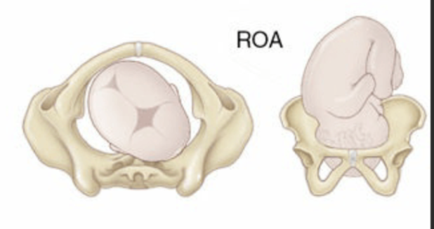 <p>back of the baby’s head is pointing toward the mother’s right front side</p><ul><li><p>Baby’s Face: the mother’s left back side</p></li><li><p>favorable position for vaginal birth</p></li></ul><p></p>