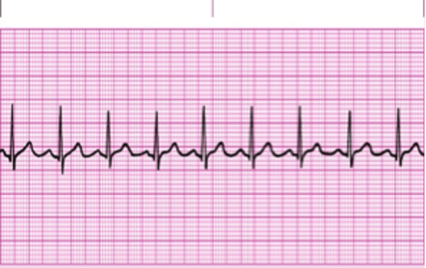 <p>Normal sinus rhythm that has heart beats regularly, with a narrow QRS complex, a consistent rate of 60-100 beats per minute, and each QRS complex is preceded by a P wave.</p>