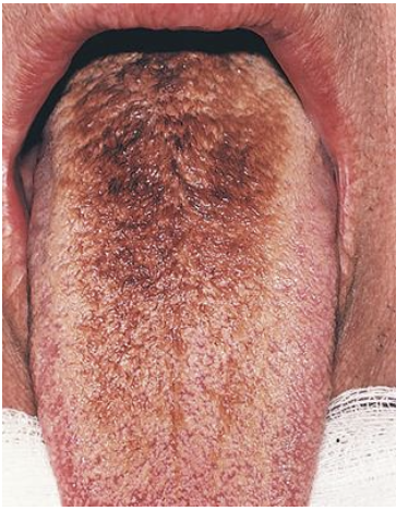 <p><strong>_____________</strong><span> occurs when the</span> usual level of shedding of <span>epithelium of the filiform lingual papillae does not occur.</span> As a result, a thick layer of dead cells and keratin builds up on the tongue surface, which becomes ___________ by tobacco, medicines, or chromogenic (colored) oral bacteria.</p>