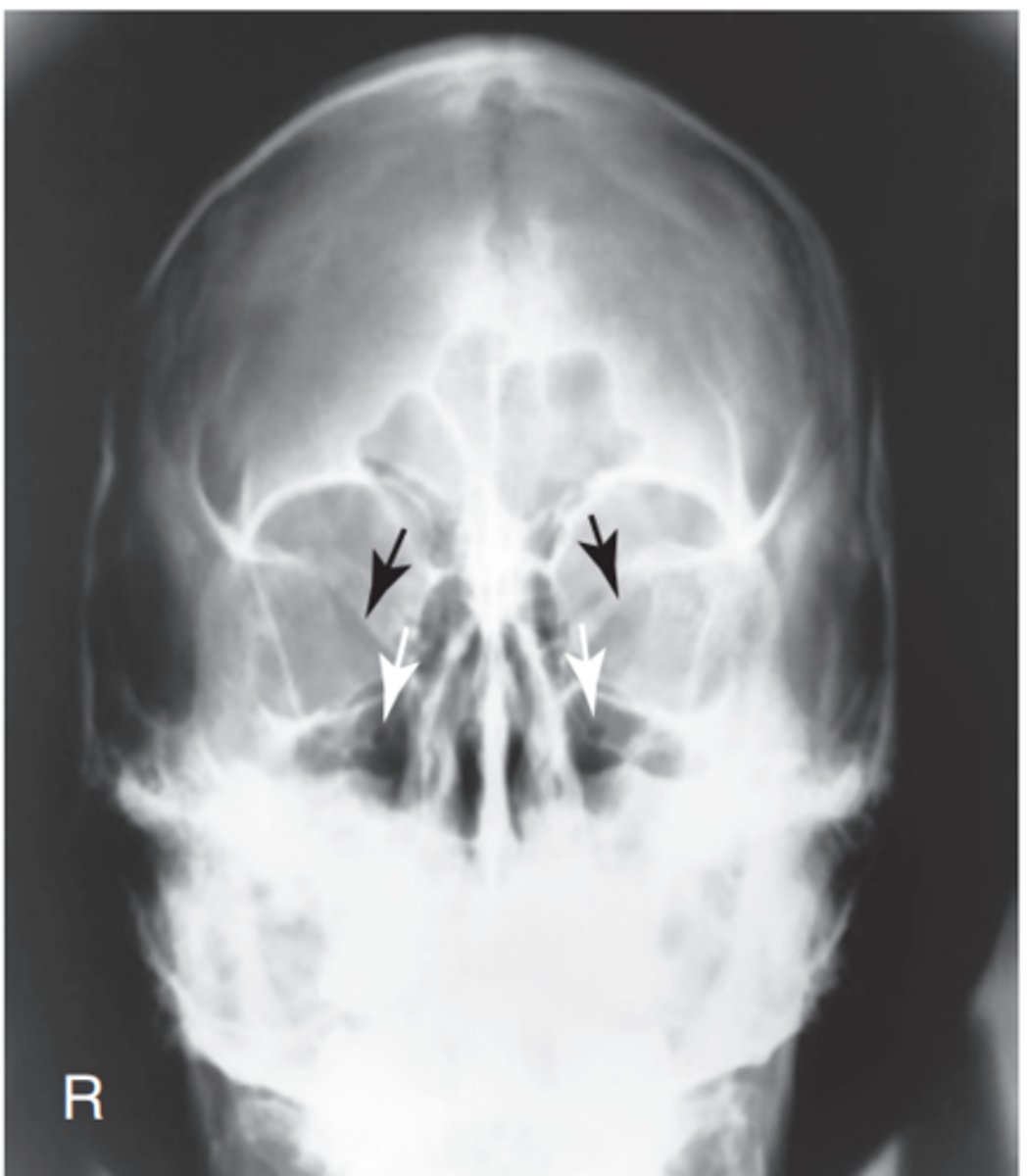 <p>-Position: No rotation as assessed by equal distance from the midlateral orbital margins to the lateral cortex of the cranium on each side, superior orbital fissures symmetric within the orbits, and correct extension of neck (OML alignment).</p><p>Petrous pyramids are projected at or just below the IOM to allow visualization of the entire orbital margin</p>