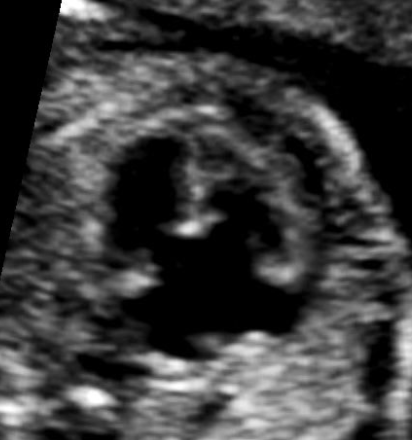<p>the findings are </p><p>a) hypoplasia left heart</p><p>b) normal 4 chamber heart</p><p>c) atrioventricular septal defect</p><p>d) tetralogy of fallot</p>