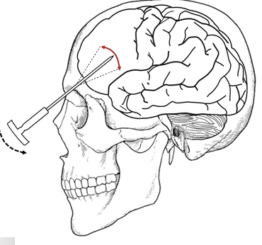 <p>frontal lobe lobotomies</p>