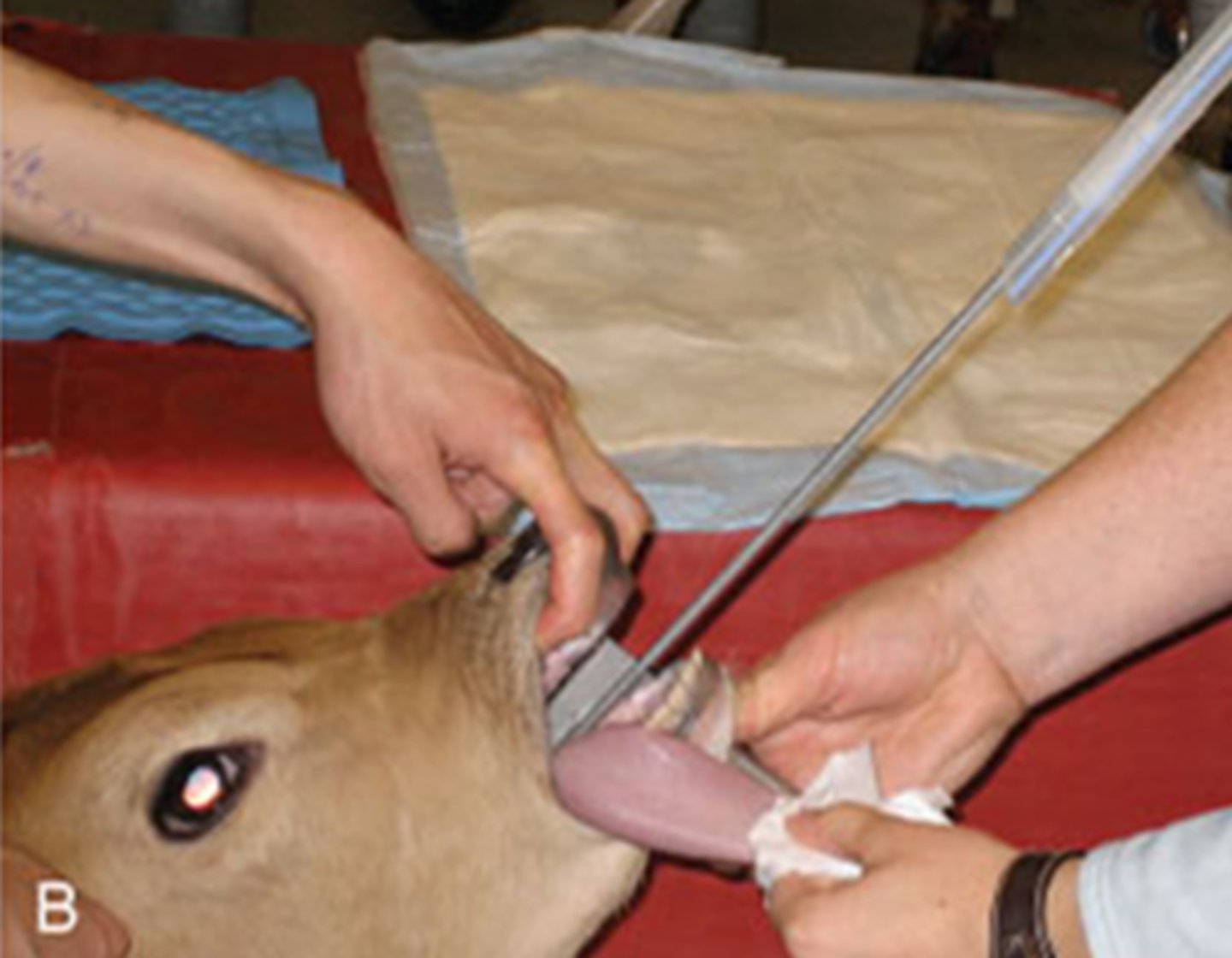 <p>The tube is then advanced over the stylette into the trachea. The stylette can then be removed.</p>