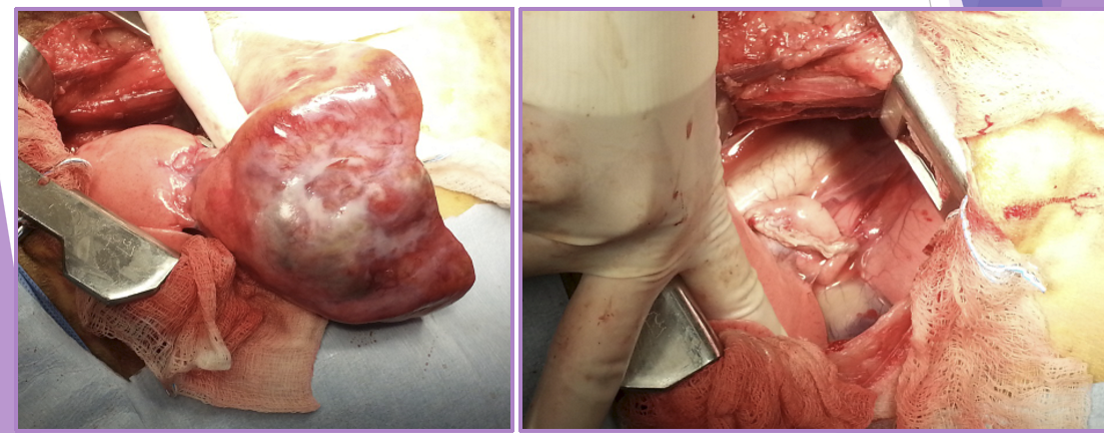 <ul><li><p>intercostal thoracotomy or median sternotomy </p></li><li><p>remove lung at pedicle </p><ul><li><p>ligate main artery, bronchus, vein </p></li><li><p>all the way to hiatus</p></li></ul></li></ul><p></p>
