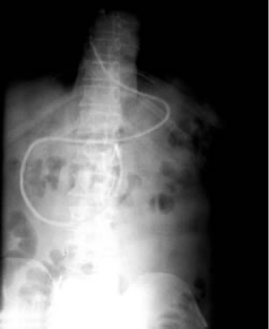<p>used to provide enteric feedings</p><p>end of tube should be in distal duodenum or jejunum- pass from left through duodenum then back right, finally back to left into jejunum</p>