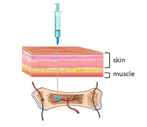 <ul><li><p>Non Collapsable Entry Point To the Venous System</p></li></ul><p></p>