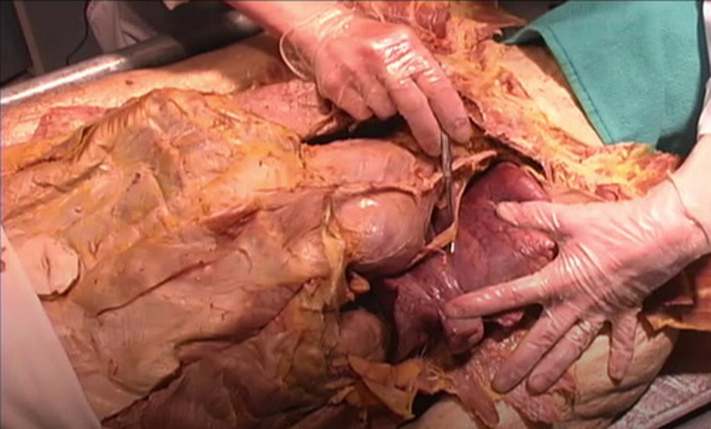 <p>What is the structure being shown here?</p><p>Optic nerve</p><p>Cranial nerve</p><p>Phrenic nerve</p><p>Trochlear nerve</p>