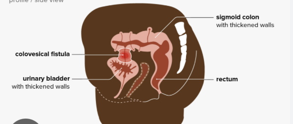 <p><em>subtypes:</em> <strong>Colovesical (most common type)</strong>, Colocutaneous, Colovaginal, Coloenteric fistulas </p><p><em>-</em><strong>Diverticulitis</strong> (most common cause), Cancer, Inflammatory Bowel Disease, Foreign body, Irradiation </p><p>Dx: CT with oral contrast, barium enema, cystogram, cystoscopy</p><p>Tx:<strong> segmental colon resection and primary anastamosi</strong>s, repair/resection of organ</p>