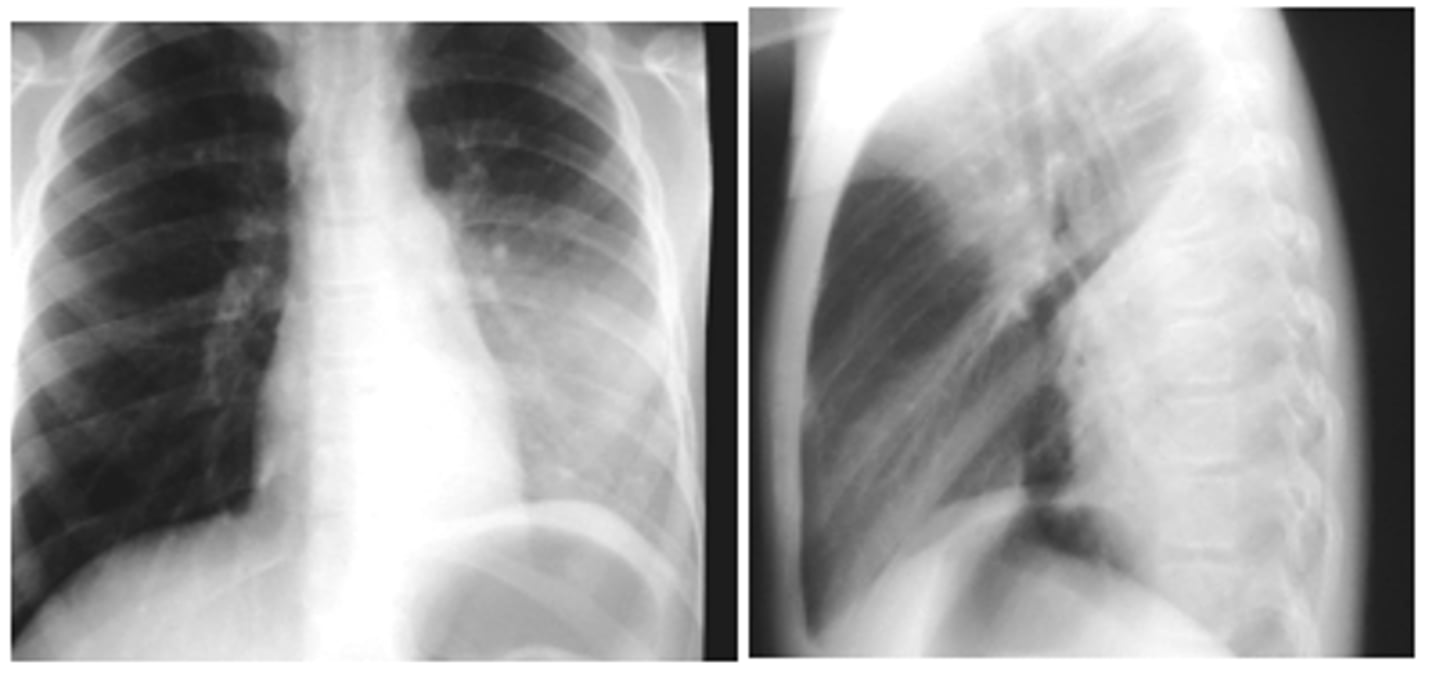 <p>LLL pneumonia</p>