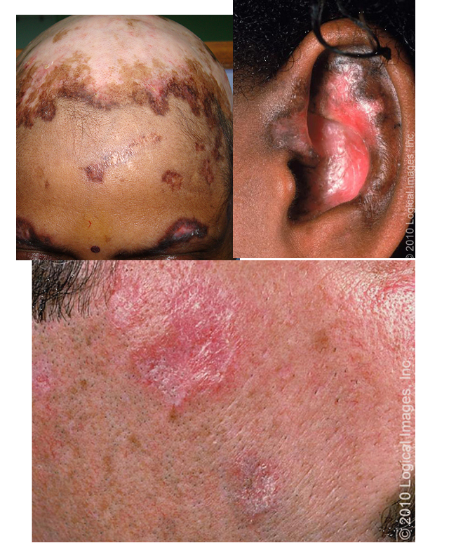 <ul><li><p>discrete, erythematous, indurated plaques covered by well-formed adherent scale that extends into dilated hair follicles</p></li><li><p>plaques heal leaving depressed central scars, atrophy, telangiectasis, and hyper or hypopigmentation</p></li><li><p><u>location</u>: face, neck, scalp, ears, upper torso</p></li><li><p><u>histology</u>: hyperkeratosis, follicular plugging, basal layer vacuole changes and mononuclear cell infiltrate at DEJ</p></li></ul><p></p>